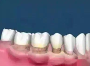 如何判斷牙周炎是輕中重度？珠海牙周治療
