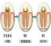 珠海牙科—乳牙根尖周病有什麼特點？
