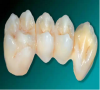 珠海牙科修復牙齒-固定義齒按修復方法和材料分為幾種？