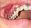 珠海箍牙—正畸支抗钉植入部位及注意事项