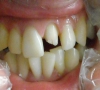 珠海牙科-鑲活動假牙好還是固定假牙好？