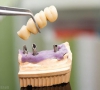 珠海牙科-牙齒拔除後多長時間鑲牙較好？