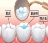  珠海牙科—窩溝封閉常見的三大問題