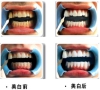 珠海牙科—為什麼強調在漂白過程中需要醫生指導？