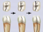 珠海睇牙，點樣判斷牙齒係唔係裂咗？