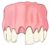 珠海牙科—牙齒缺失鑲牙之前的準備