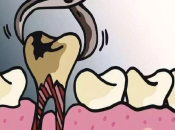 珠海睇牙，牙齒剝咗之後一定要植牙嗎？
