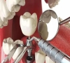 珠海種植牙—種牙牙齦會萎縮嗎？對牙齦有傷害嗎？