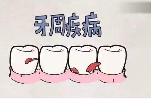 牙周病具體可以分為哪幾種？