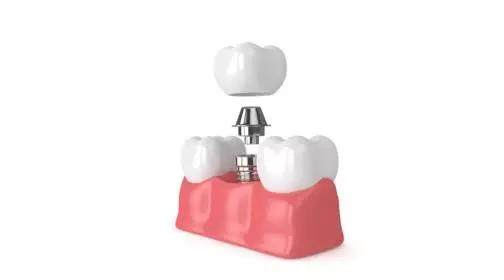 常用的缺牙修復方式有哪些？