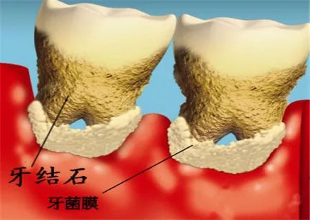 牙結石是如何形成的