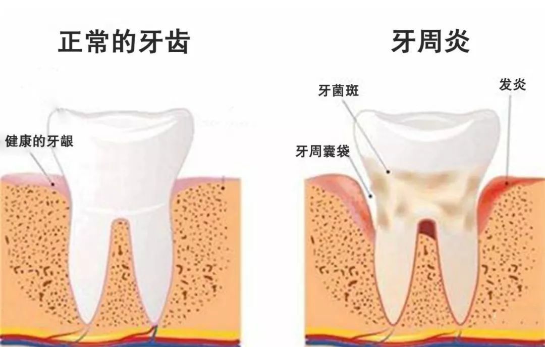 牙髓炎與牙周炎有什麼關系