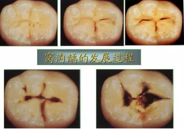 蛀牙齲齒