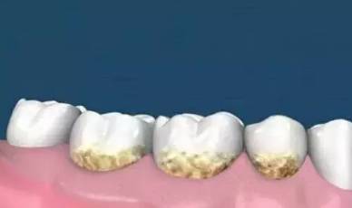 牙周不好末期疾病的表現