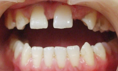 儿童年輕恒牙外傷後牙部分脫出如何處理？