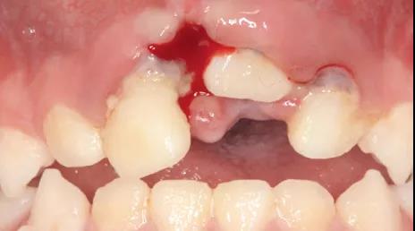兒童恒牙外傷挫入牙槽窩中如何處理？