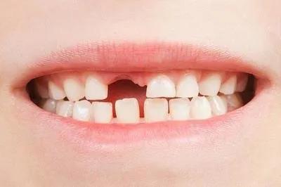 年輕恒牙早失的原因及危害有哪些？應該做何處理？