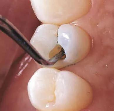 兒童生長發育過程中的年齡分期及牙齒保護1
