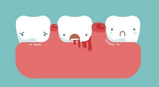 什麼是妊娠性牙齦炎？