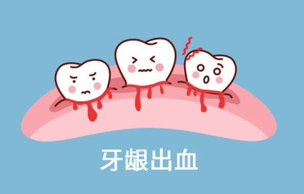 牙颈部出血即牙周病的开始