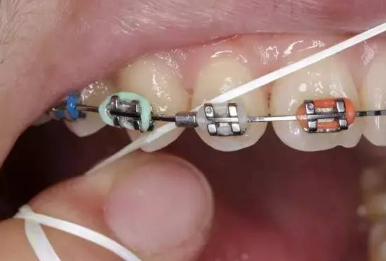箍牙過程中應如何注意口腔護理?