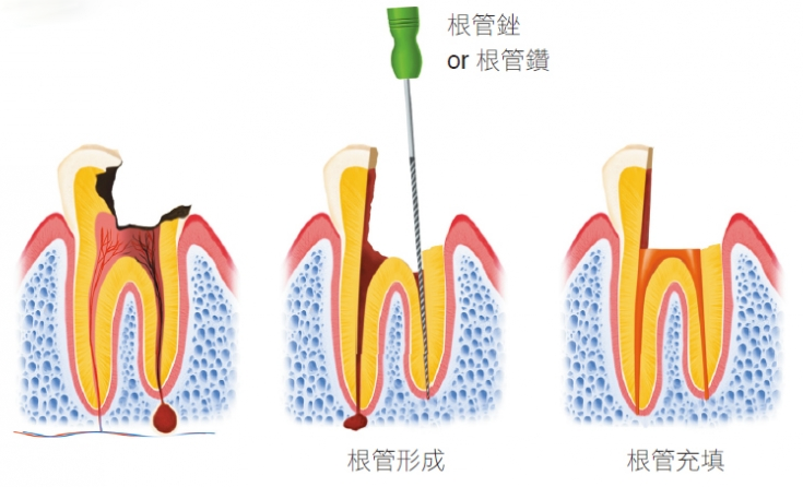 老年人患牙髓炎有什麼危害？