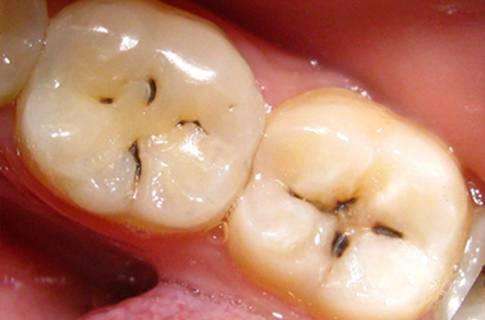 你知道蛀牙是會傳染的嗎？
