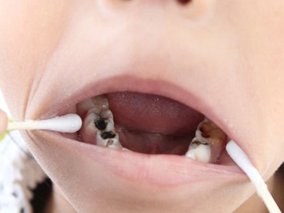 珠海補牙—乳牙出現齲齒有哪些危害