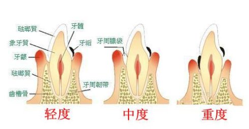 牙周炎如何治療