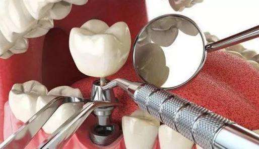 珠海種牙—種植牙相對傳統的義齒有什麼優點？