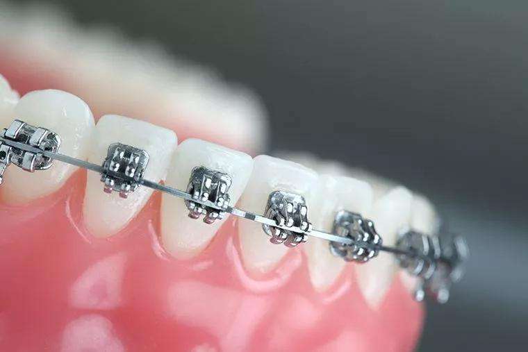 矯正牙齒可能帶來的4個後遺症
