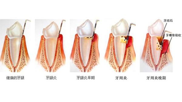 為什麼會出現牙齒松動？