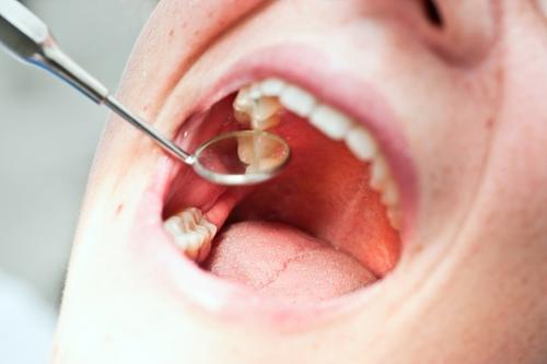 齲齒與其他牙體病的鑒別診斷-珠海維港口腔