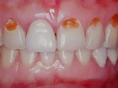 珠海補牙—什麼是楔形缺損？有什麼危害嗎？