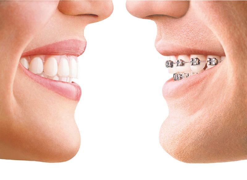 牙齒矯正會出現牙套臉嗎？