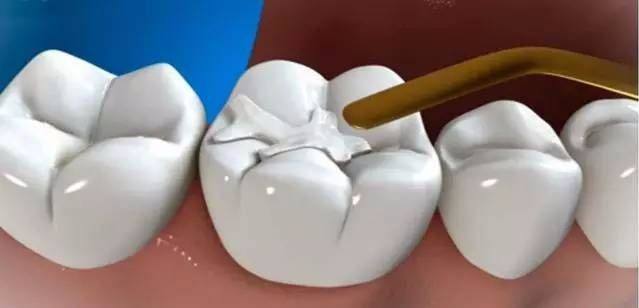 補牙的7個小技巧，你掌握了多少？
