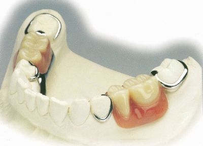 珠海鑲牙—鑲牙前需要注意什麼？