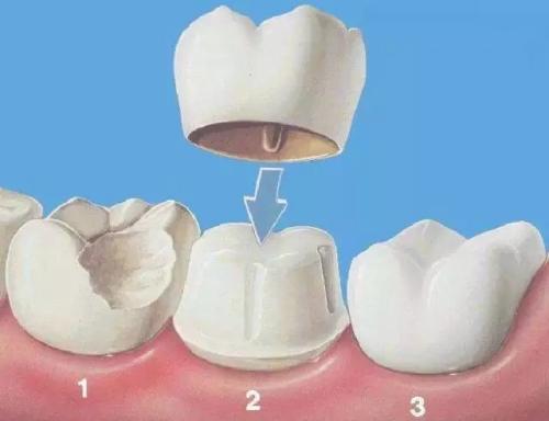 固定義齒（假牙）有什麼優缺點？