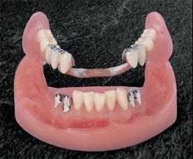 珠海牙科—佩戴全口義齒會出現什麼問題？