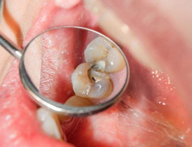 孩子牙齒上的黑斑是什麼？