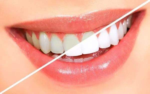 怎麼使牙齒變白？