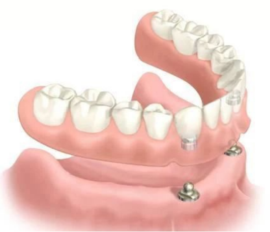 珠海牙科—什麼是覆蓋義齒？