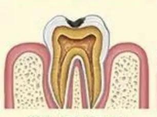 珠海維港口腔鏈鎖-補牙為什麼要用牙鑽磨牙？