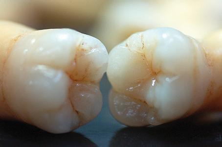 珠海維港口腔鏈鎖-什麼時候給兒童補牙最合適？