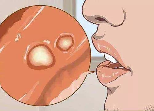 珠海牙科—引起口腔潰瘍有什麼原因？