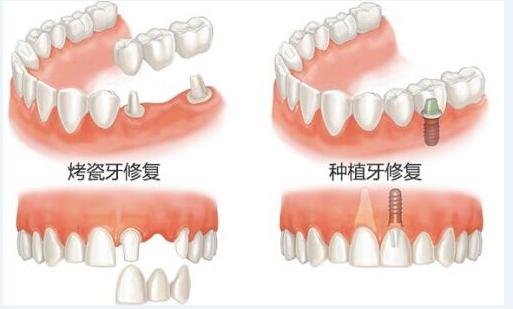 种植牙1