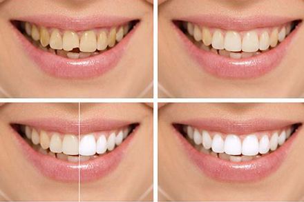 珠海牙科—怎樣才能使黑黃牙美白？