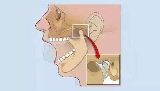 珠海牙科—顯下頜關節怎麼防治？