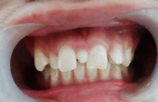 珠海牙科—什麼是“多生牙”？怎麼防治？