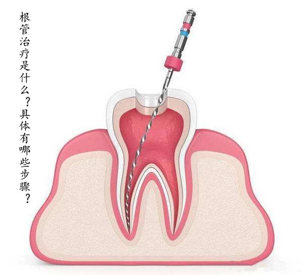 根管治疗